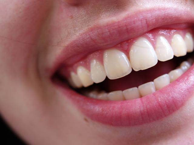Tooth Whitening Services in Wirral